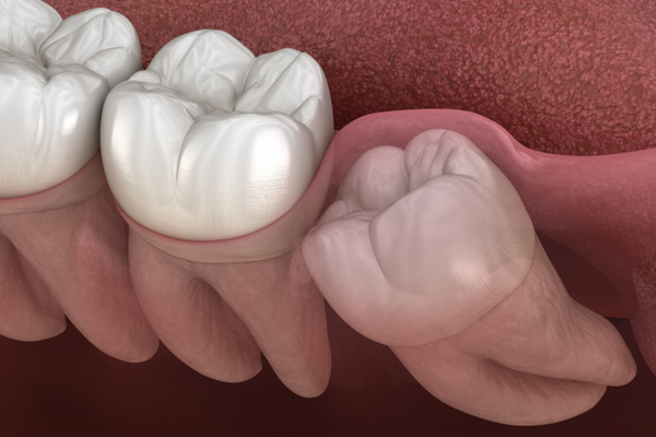 Extractions