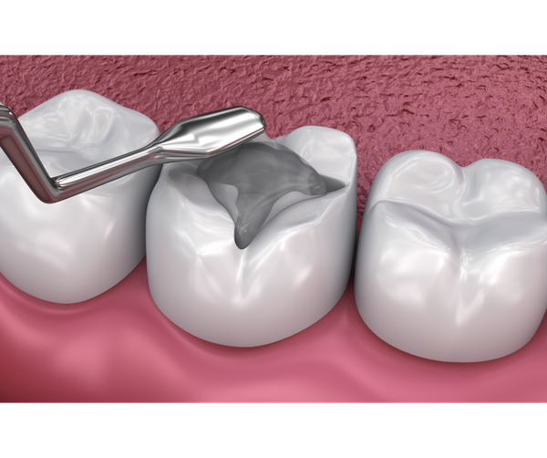 Root Canals